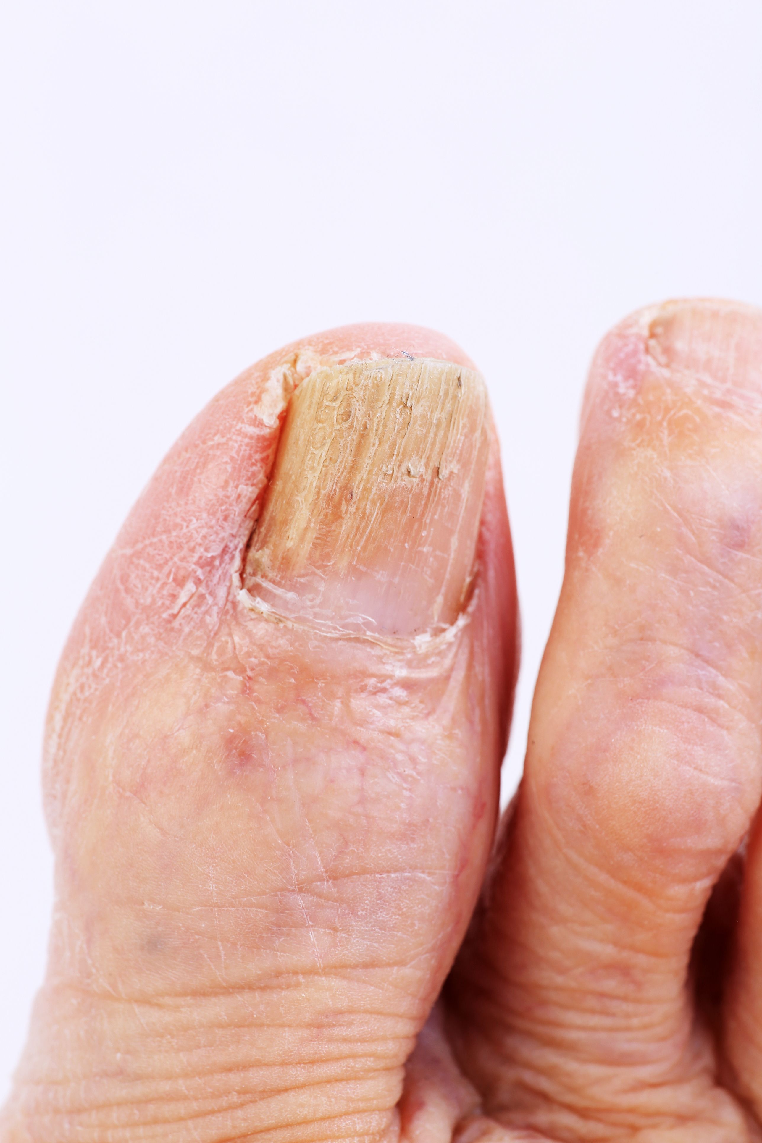 3 formas de deshacerte de las uñas amarillas en los pies